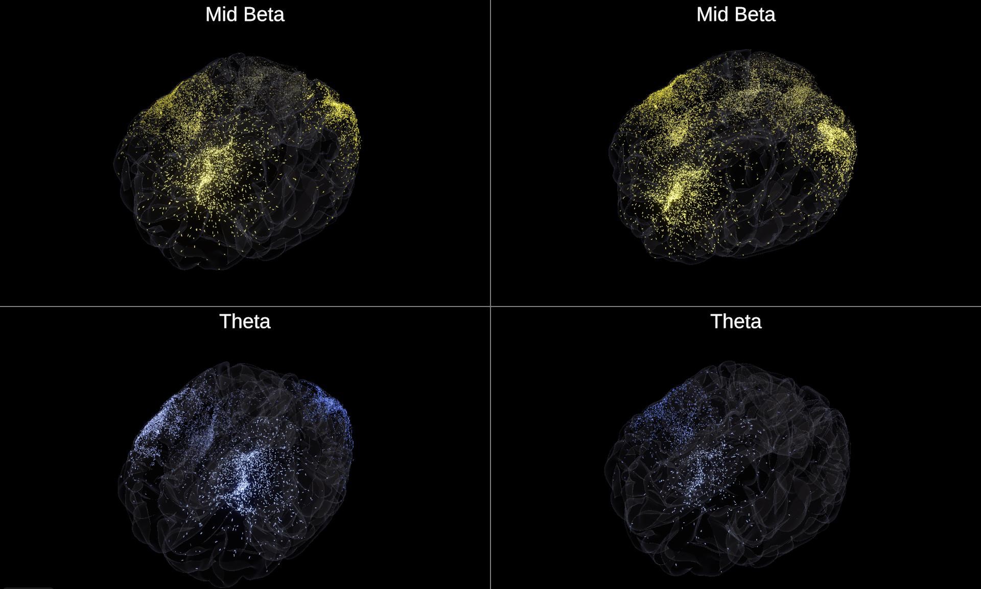 qEEG brain map from a NeuraLearn client showing elevated frontal theta activity