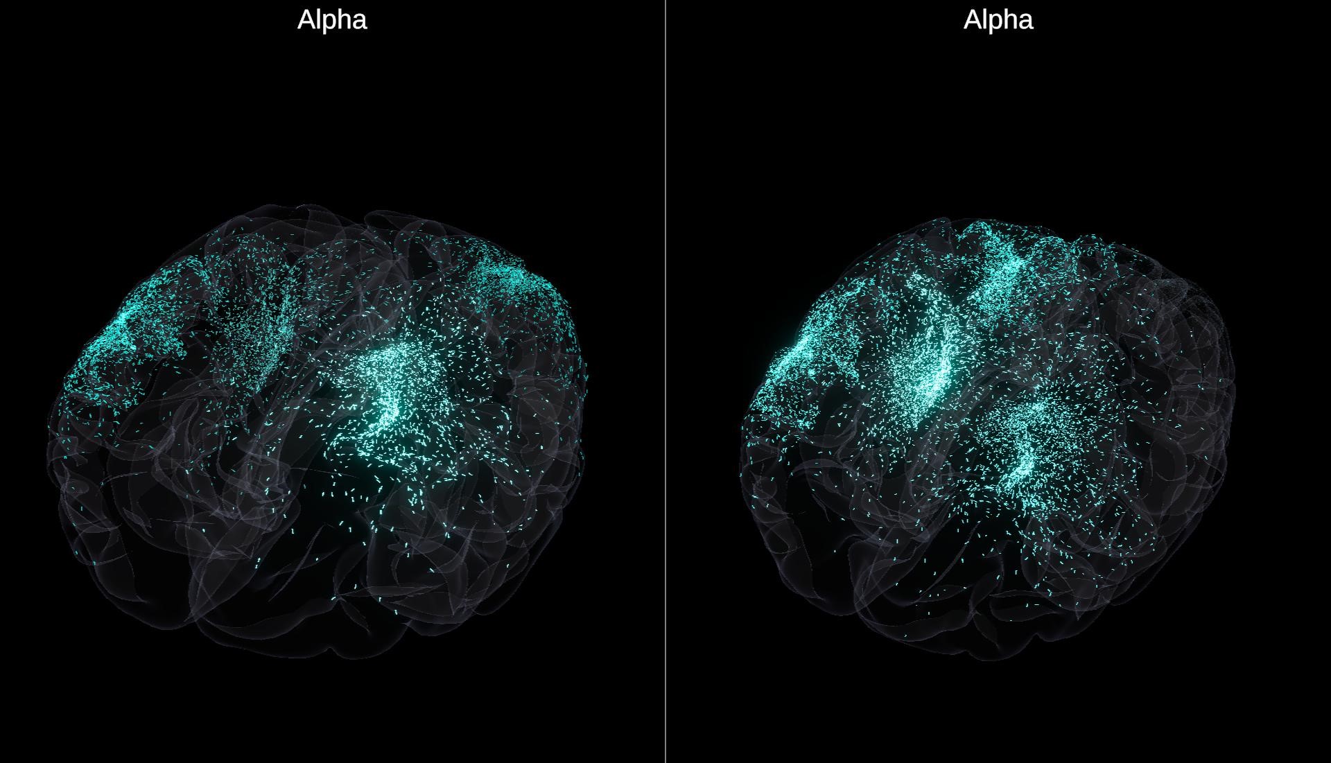 qEEG brain map from a NeuraLearn client showing suppressed frontal alpha and elevated high-beta activity